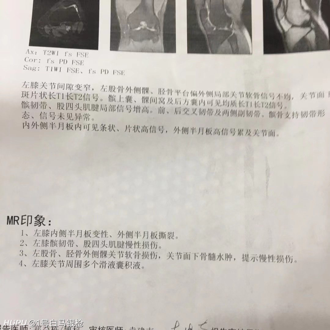 外侧半月板撕裂要咋整