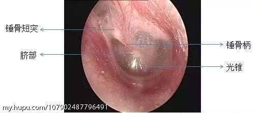 鼓膜穿孔是怎么引起的 虎扑