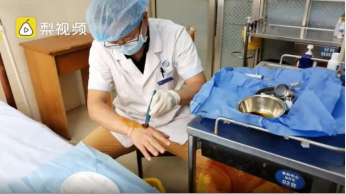 是个狠人！四川骨科大夫左手给右手做手术 消毒、麻醉再开刀3分钟搞定