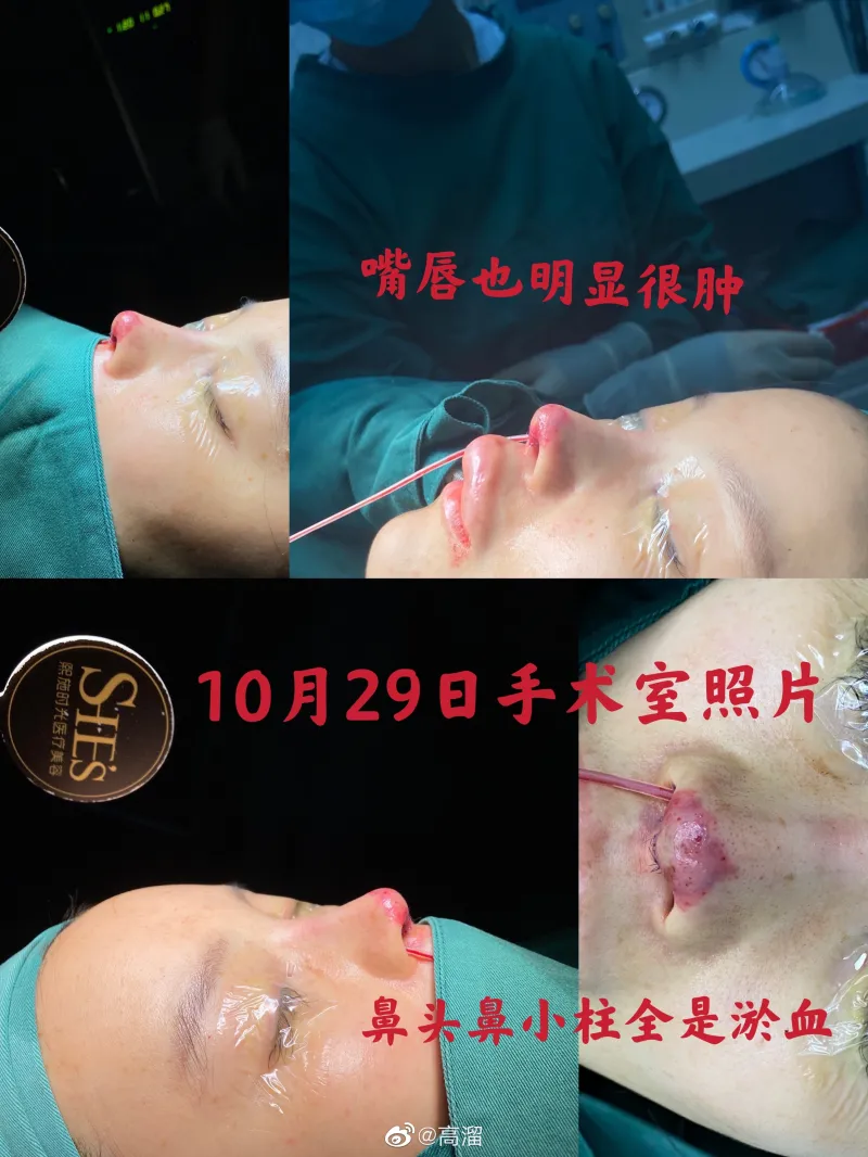 演员高溜整容失败鼻尖坏死 这事你怎么看 影视区 虎扑社区