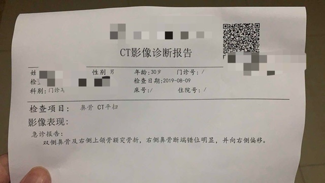 打球鼻子被打歪了会自己恢复到什么程度 虎扑