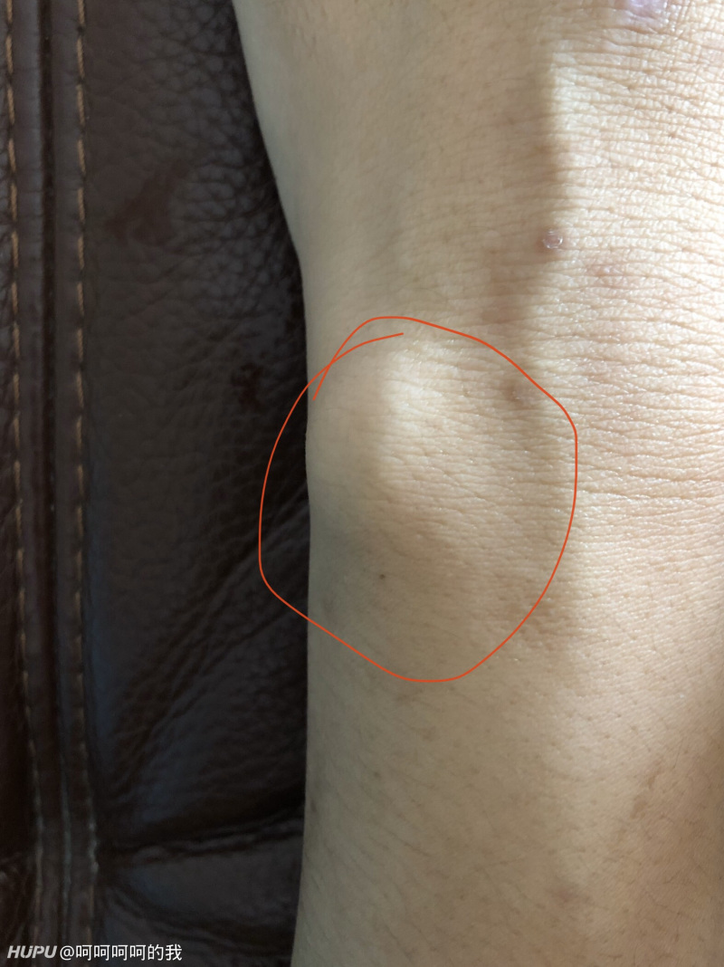 两手腕同个位置痛,怎么回事又不肿,痛了好几个月了,有事扭瓶盖都都扭