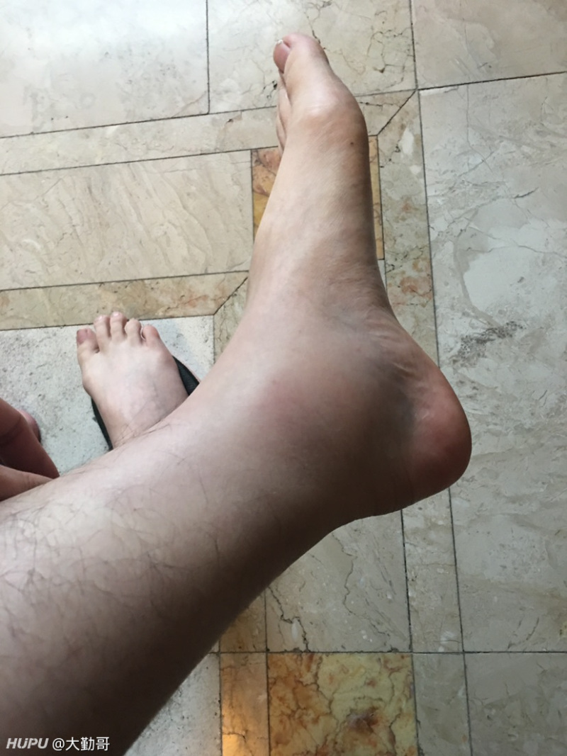 我跟腱断裂过,觉得kd的症状不像是断裂