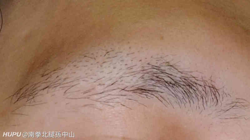 有一边眉毛突然掉了一半 还能长回来吗 虎扑 有一边眉毛突然掉了一半 还能长回来吗 虎扑