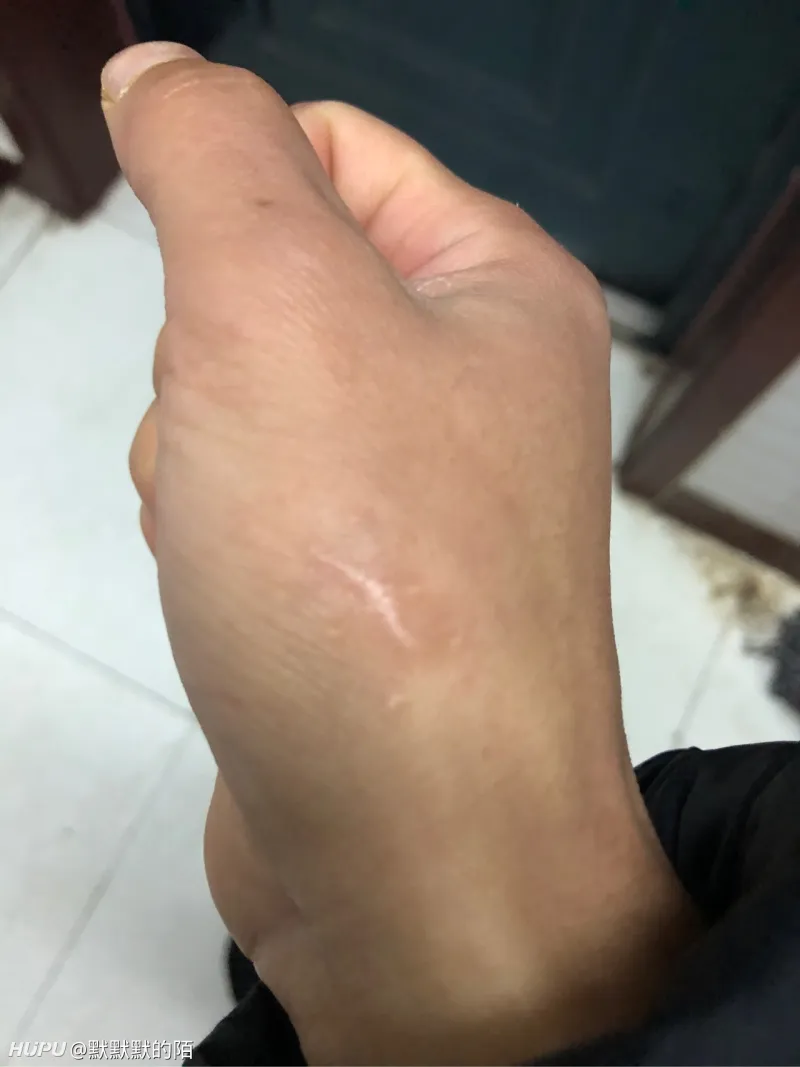 伴随我五年的伤疤终于没了，什么水平？