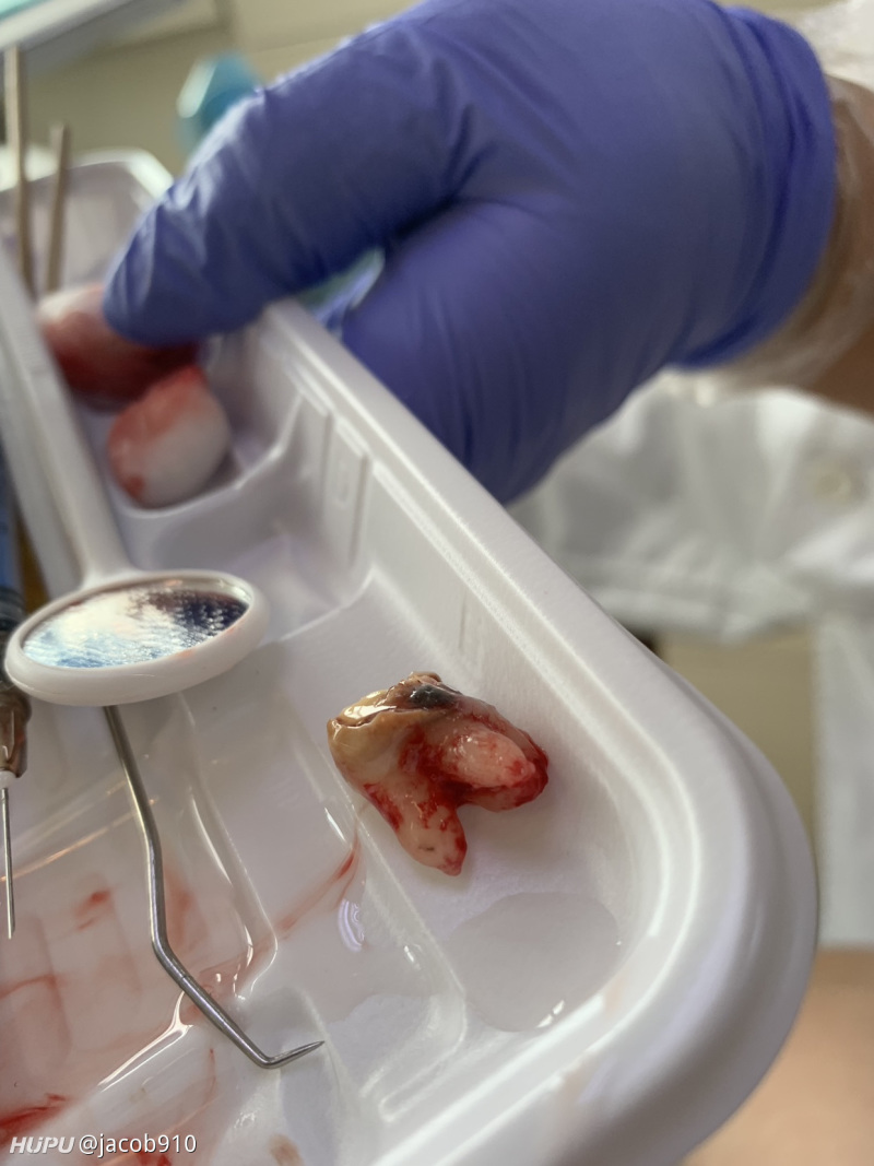 今天刚刚拔的智齿,什么水平