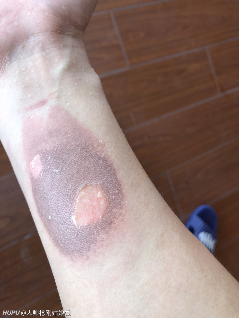 Jr们我这个手臂不小心被烫伤了会留下伤疤吗 虎扑