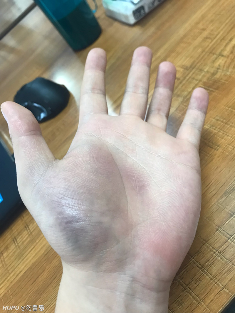 有没有老哥大拇指关节囊受损的?