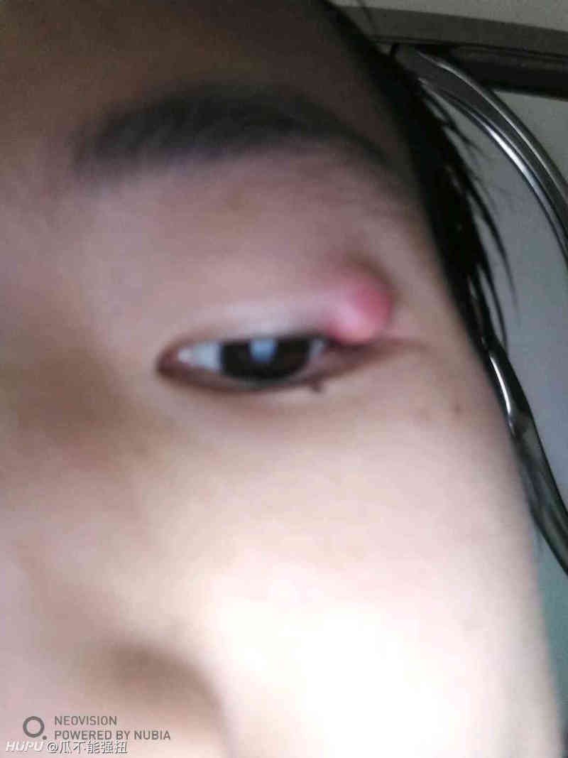 眼睛长了个泡 有jr知道怎么了吗 虎扑