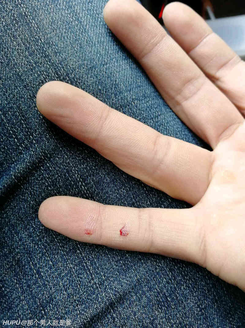 从照片能看出来被啥蛇咬了么_虎扑