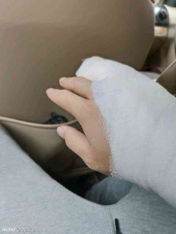 高考前右手小指骨折 真的倒霉 步行街主干道 虎扑社区