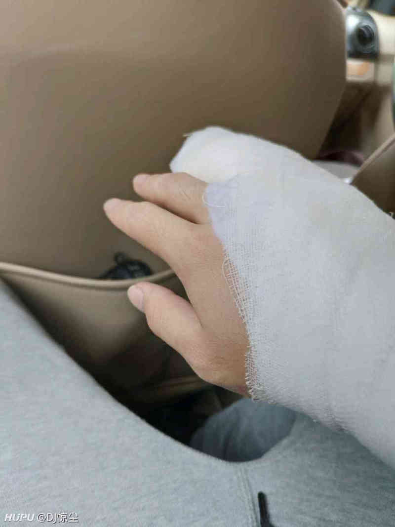 高考前右手小指骨折 真的倒霉 虎扑 高考前右手小指骨折 真的倒霉 虎扑
