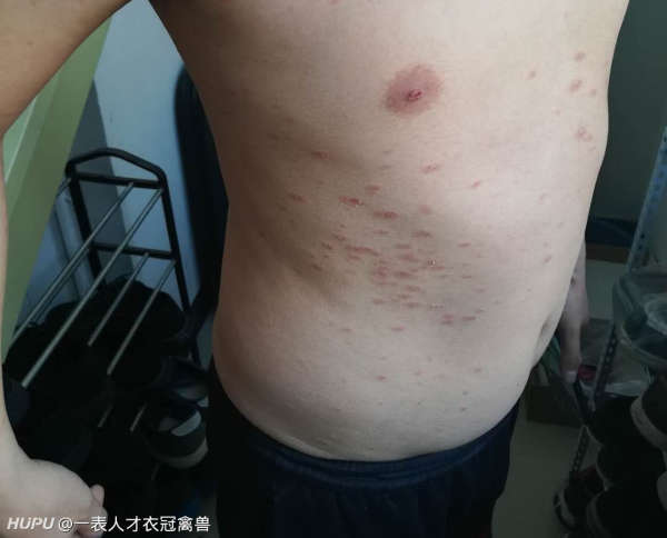 小弟求助！ “玫瑰糠疹”，如何治啊？
