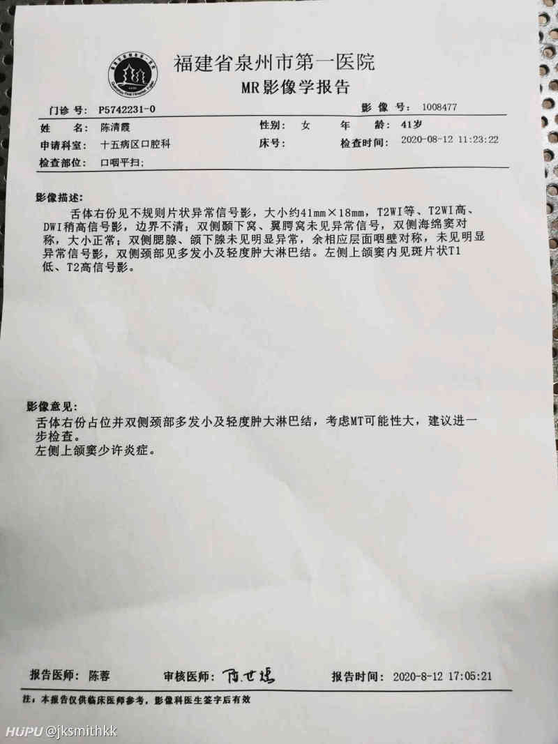 舌癌求医生家人们给点意见 虎扑