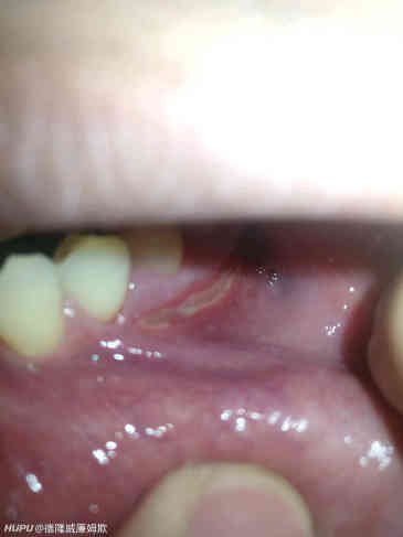 热点话题 Jrs觉得口腔溃疡有多难受 虎扑